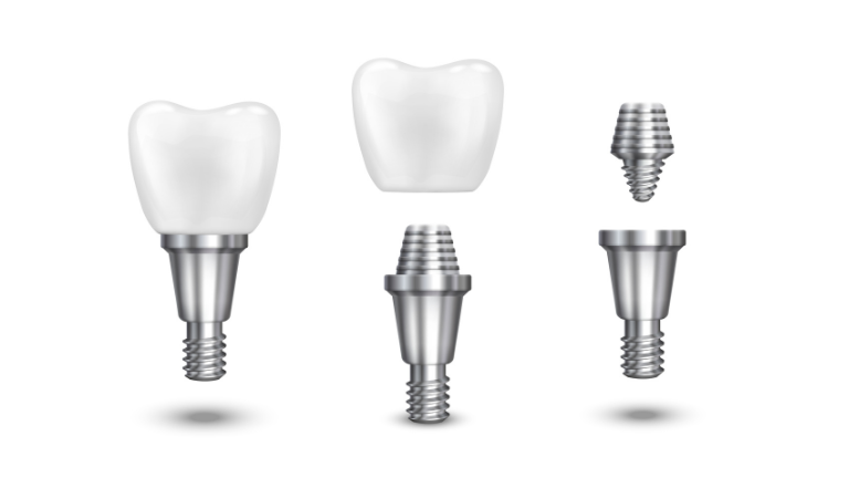 implantes dentales en comparación con más opciones