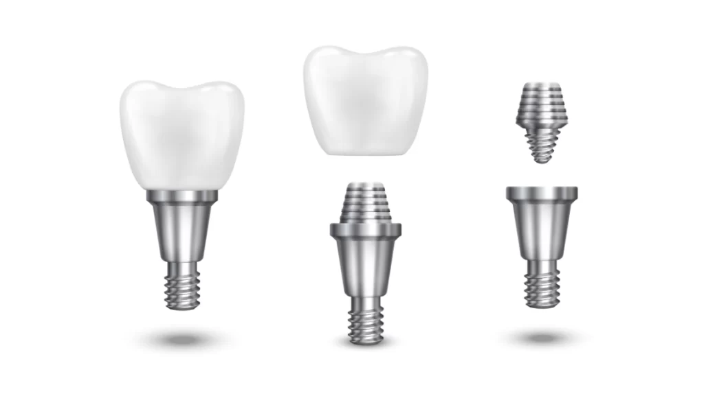 implantes dentales en comparación con otras opciones