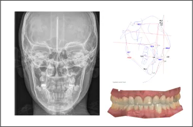 Modelos dentales digitales