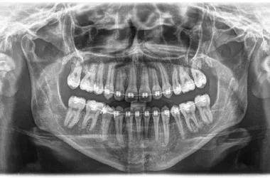 Rx Panorámica Dental