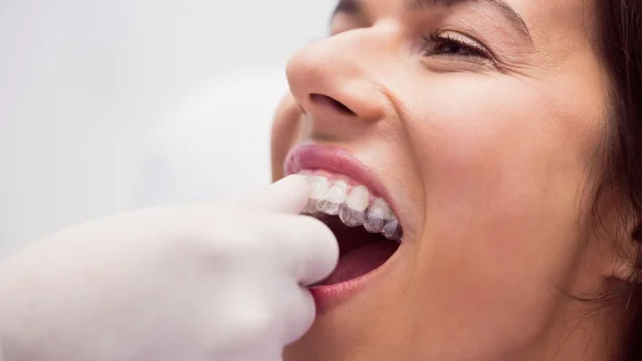 Como usar y limpiar las férulas Invisalign