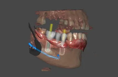 Registros para planeación de rehabilitación oral.